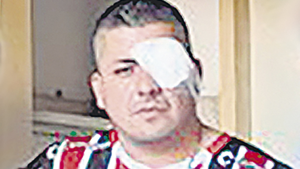 Perdió la visión de un ojo