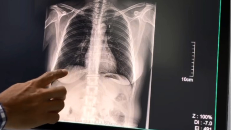 Cuatro de cada diez pacientes lograron dejar de fumar gracias a un programa del Hospital Marcial Quiroga