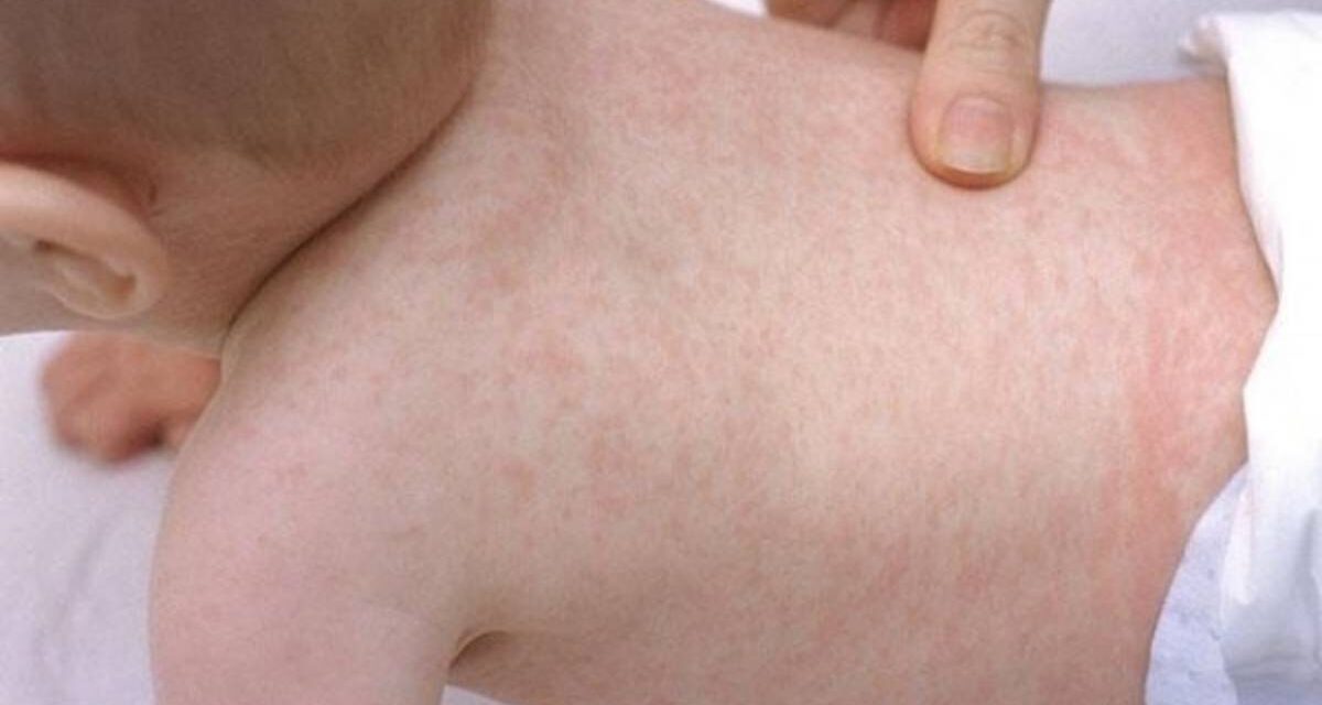 Descartaron un caso de sarampión en un bebé de Caucete: el niño está en buen estado de salud