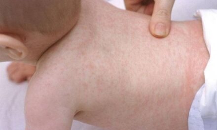 Descartaron un caso de sarampión en un bebé de Caucete: el niño está en buen estado de salud